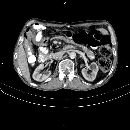 Ampullary adenocarcinoma (Radiopaedia 86093-102033 B 63).jpg
