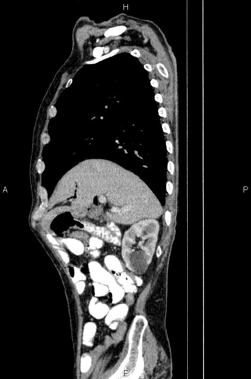 Ampullary adenocarcinoma (Radiopaedia 86093-102033 E 24).jpg