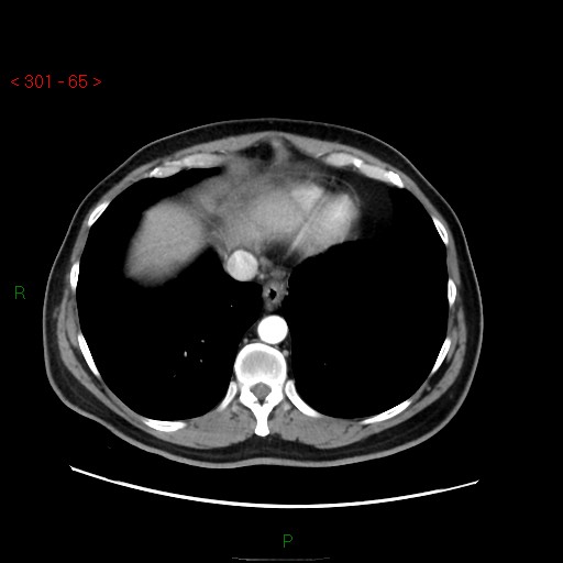File:Ampullary carcinoma (Radiopaedia 56396-63056 B 11).jpg