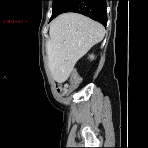 Ampullary carcinoma (Radiopaedia 56396-63056 D 21).jpg
