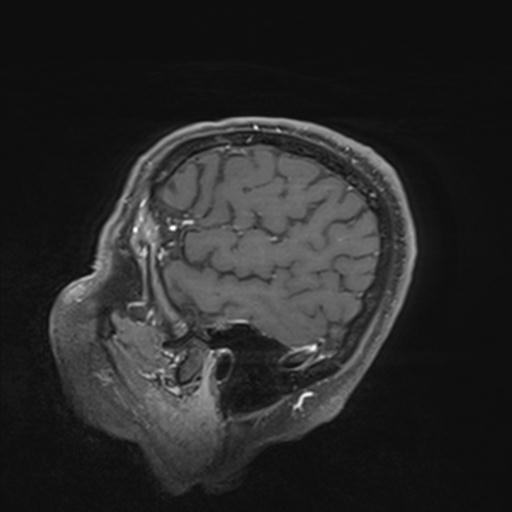 Amyloid angiopathy with inflammation (Radiopaedia 30360-31002 M 23).jpg