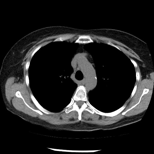 Amyloidosis - bronchial and diffuse nodular pulmonary involvement (Radiopaedia 60156-67744 Axial non-contrast 19).jpg