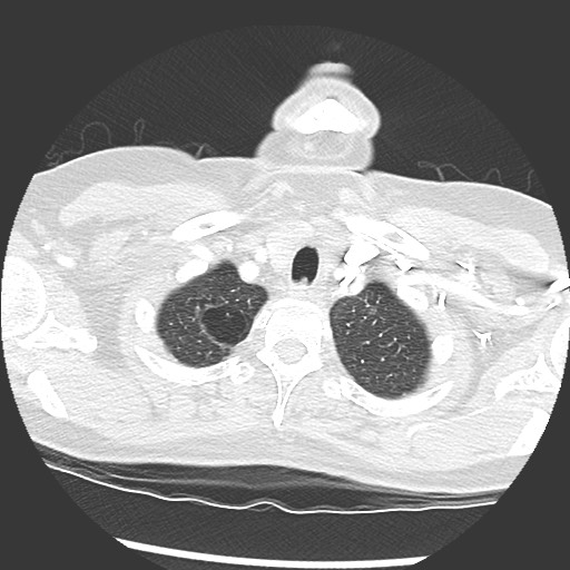 Amyloidosis - bronchial and diffuse nodular pulmonary involvement (Radiopaedia 60156-67745 Axial lung window 5).jpg