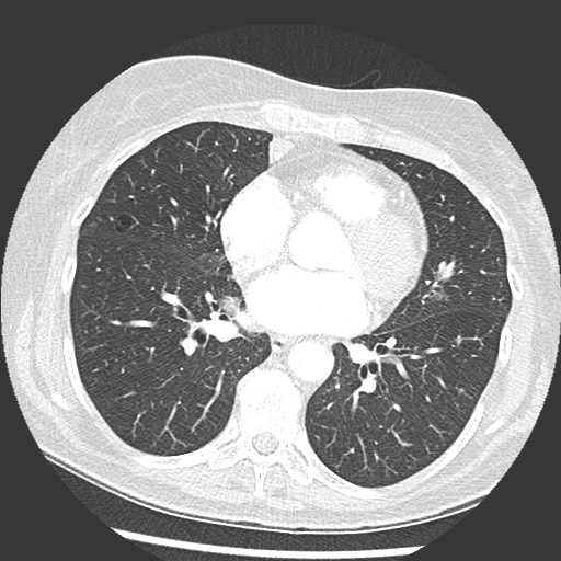 Amyloidosis - bronchial and diffuse nodular pulmonary involvement (Radiopaedia 60156-67745 Axial lung window 50).jpg