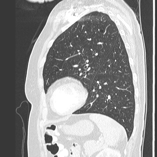 File:Amyloidosis - bronchial and diffuse nodular pulmonary involvement (Radiopaedia 60156-67745 Sagittal lung window 67).jpg