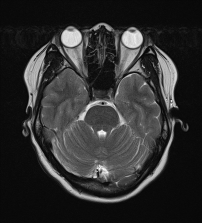 File:Anaplastic astroblastoma (Radiopaedia 55666-62194 Axial T2 9).png