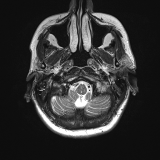 File:Anaplastic astrocytoma - thalamic glioma (Radiopaedia 59709-67115 Axial T2 4).png