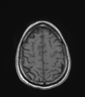 Anaplastic astrocytoma IDH wild-type (Radiopaedia 49984-55273 Axial T1 46).png