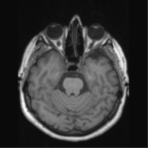 File:Anaplastic astrocytoma IDH wild-type (pseudoprogression) (Radiopaedia 42209-45276 Axial T1 56).png