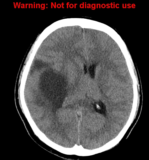 File:Anaplastic ganglioglioma (Radiopaedia 44921-48815 Axial non-contrast 15).jpg