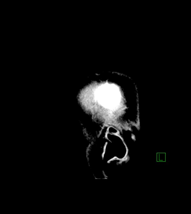 Anaplastic oligodendroglioma (Radiopaedia 79571-92753 C 53).jpg