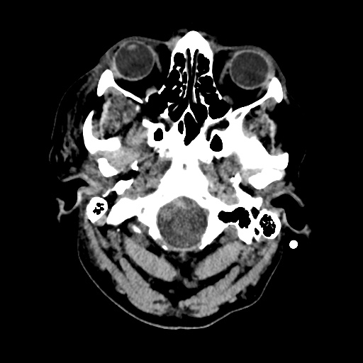 Aneursym related subarachnoid hemorrhage with hydrocephalus (Radiopaedia 45105-49085 Axial non-contrast 3).jpg