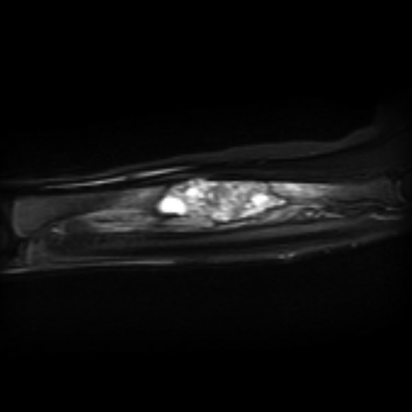 File:Aneurysmal bone cyst - radius (Radiopaedia 5866-7442 Coronal PD fat sat 1).jpg