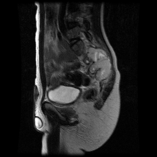 File:Aneurysmal bone cyst - sacrum (Radiopaedia 65190-74196 Sagittal T2 14).jpg