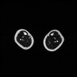 File:Aneurysmal bone cyst - tibia (Radiopaedia 22343-22367 Axial T2 2).jpg