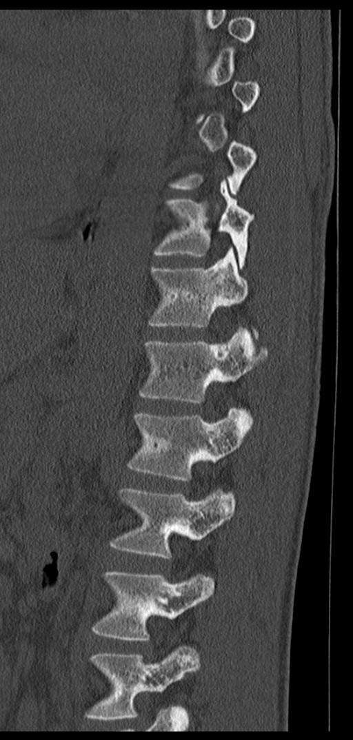Aneurysmal bone cyst T11 (Radiopaedia 29294-29721 Sagittal bone window 28).jpg