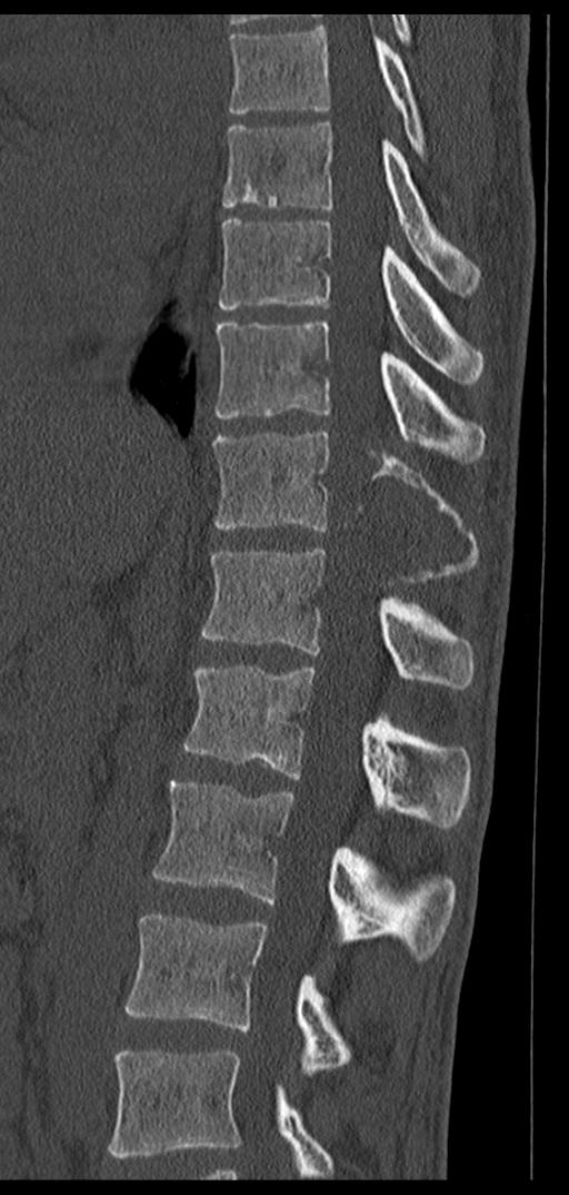 Aneurysmal bone cyst T11 (Radiopaedia 29294-29721 Sagittal bone window 39).jpg