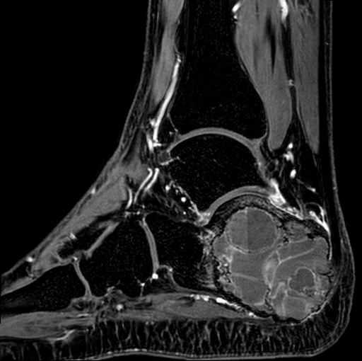 File:Aneurysmal bone cyst of the calcaneus (Radiopaedia 60669-68420 F 20).jpg