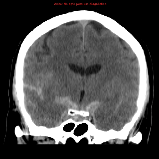 File:Aneurysmal subarachnoid hemorrhage (Radiopaedia 24740-24997 Coronal non-contrast 21).jpg