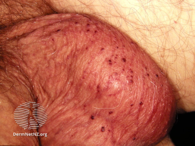File:Angiokeratoma of Fordyce on scrotum (DermNet NZ angiokeratoma-05).jpg