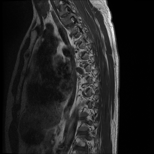 File:Angiolipoma - thoracic spine (Radiopaedia 28242-28479 Sagittal T1 3).jpg
