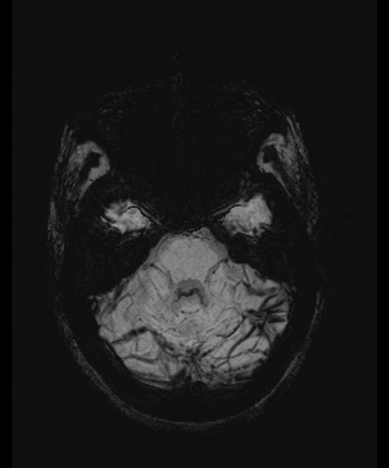 Angiomatous meningioma (Radiopaedia 79459-92579 E 16).jpg