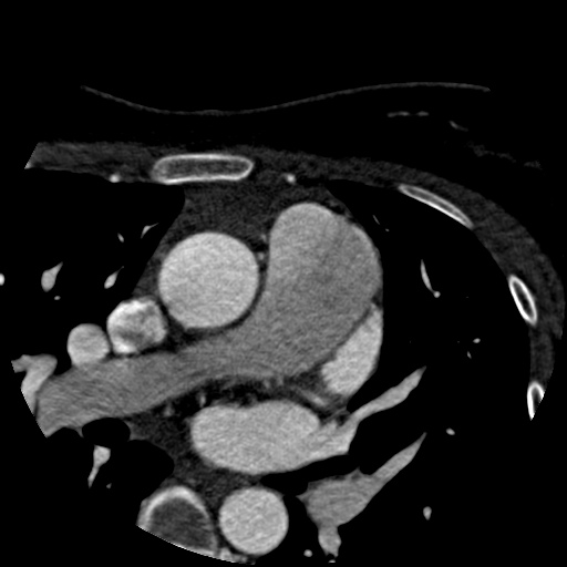 File:Anomalous left coronary artery from the pulmonary artery (ALCAPA) (Radiopaedia 40884-43586 A 6).jpg