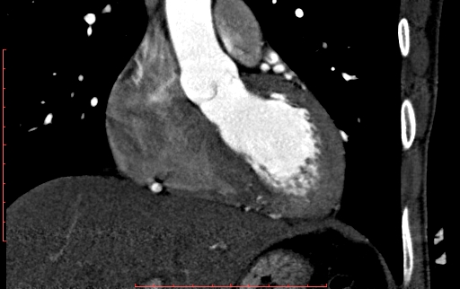 Anomalous left coronary artery from the pulmonary artery (ALCAPA) (Radiopaedia 70148-80181 B 126).jpg