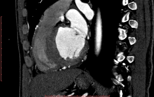 File:Anomalous left coronary artery from the pulmonary artery (ALCAPA) (Radiopaedia 70148-80181 C 151).jpg