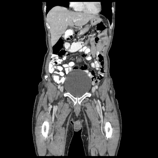 Anorectal carcinoma (Radiopaedia 44413-48064 B 17).jpg