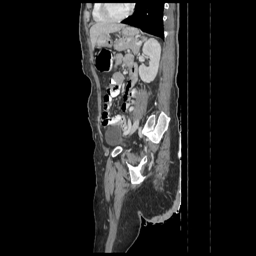 File:Anorectal carcinoma (Radiopaedia 44413-48064 C 72).jpg