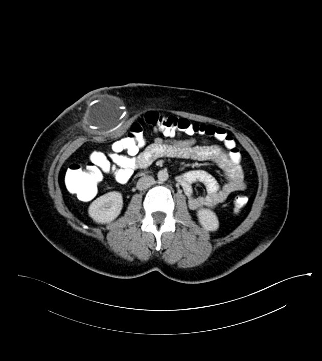 Anterior abdominal wall CSF pseudocyst (CSFoma) (Radiopaedia 79453-92571 A 47).jpg