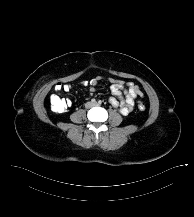 Anterior abdominal wall CSF pseudocyst (CSFoma) (Radiopaedia 79453-92571 A 57).jpg