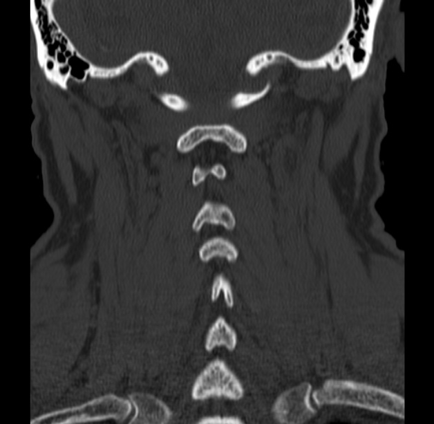 Anterior cervical postdiscectomy arthrodesis (Radiopaedia 32678-33646 Coronal bone window 50).jpg