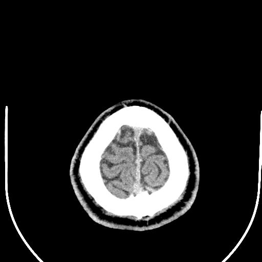 Anterior choroidal artery infarct (Radiopaedia 55106-61480 Axial non-contrast 61).jpg