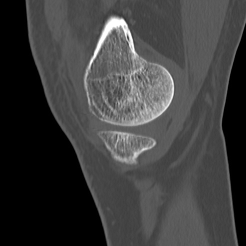 File:Anterior cruciate ligament avulsion fracture (Radiopaedia 58939-66194 Sagittal bone window 34).jpg