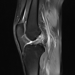 File:Anterior cruciate ligament full thickness tear (Radiopaedia 66268-75467 Sagittal PD fat sat 13).jpg