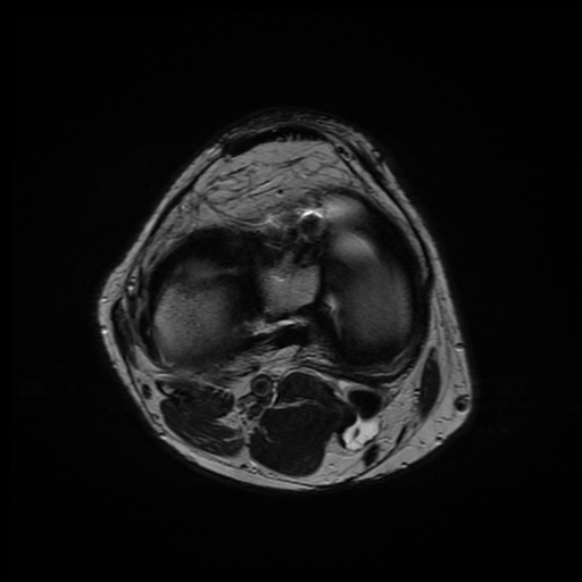 File:Anterior cruciate ligament graft tear and bucket-handle tear of medial meniscus (Radiopaedia 75867-87254 Axial T2 10).jpg