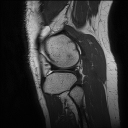 Anterior cruciate ligament rupture and posteromedial corner injury (Radiopaedia 67338-76723 Sagittal PD 136).jpg