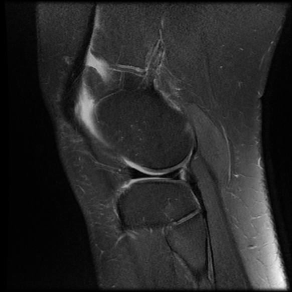File:Anterior cruciate ligament tear, Wrisberg rip and bucket-handle tear of medial meniscus (Radiopaedia 75872-87266 Sagittal PD fat sat 5).jpg