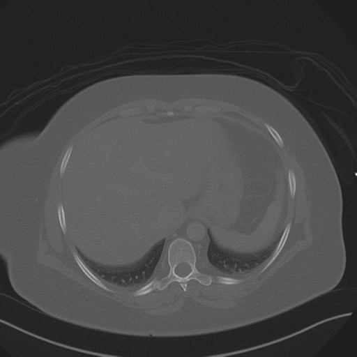 Anterior superior iliac spine avulsion fracture (Radiopaedia 44541-48244 Axial bone window 17).png