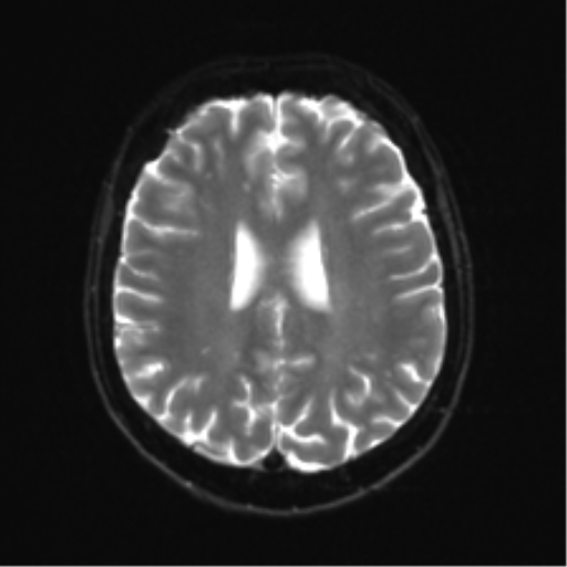 Anterior temporal lobe perivascular space (Radiopaedia 40946-43650 Axial DWI 18).png