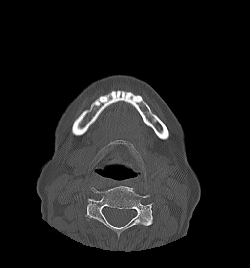 File:Anterior temporomandibular joint dislocation (Radiopaedia 59430-66784 Axial non-contrast 53).jpg