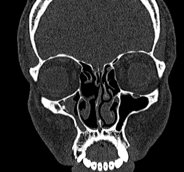 Antrochoanal polyp (Radiopaedia 30002-30554 Coronal bone window 29).jpg