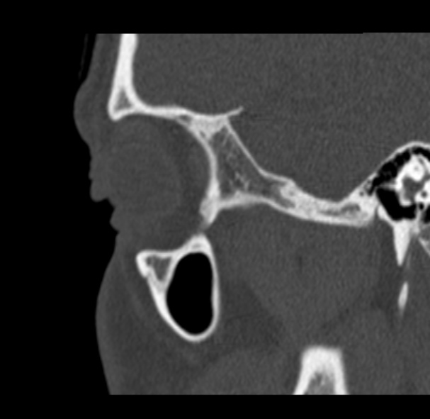 Antrochoanal polyp (Radiopaedia 33984-35202 Sagittal bone window 74).jpg