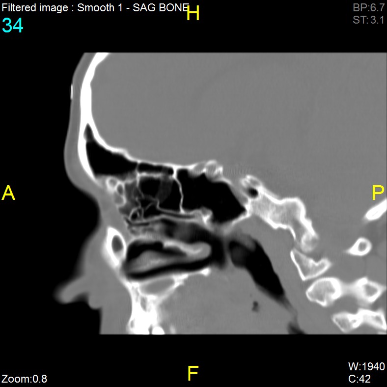 Antrochoanal polyp (Radiopaedia 65101-74094 Sagittal bone window 34).jpg