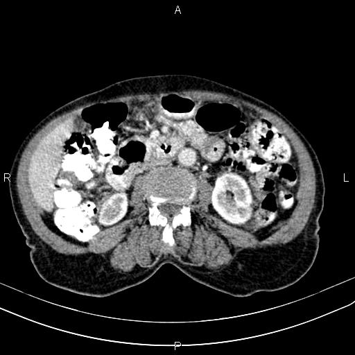 Aortic aneurysm and Lemmel syndrome (Radiopaedia 86499-102554 A 41).jpg