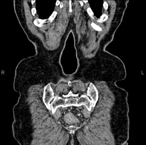 Aortic aneurysm and Lemmel syndrome (Radiopaedia 86499-102554 C 63).jpg