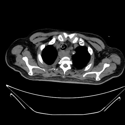 Aortic arch aneurysm (Radiopaedia 84109-99365 Axial non-contrast 48).jpg