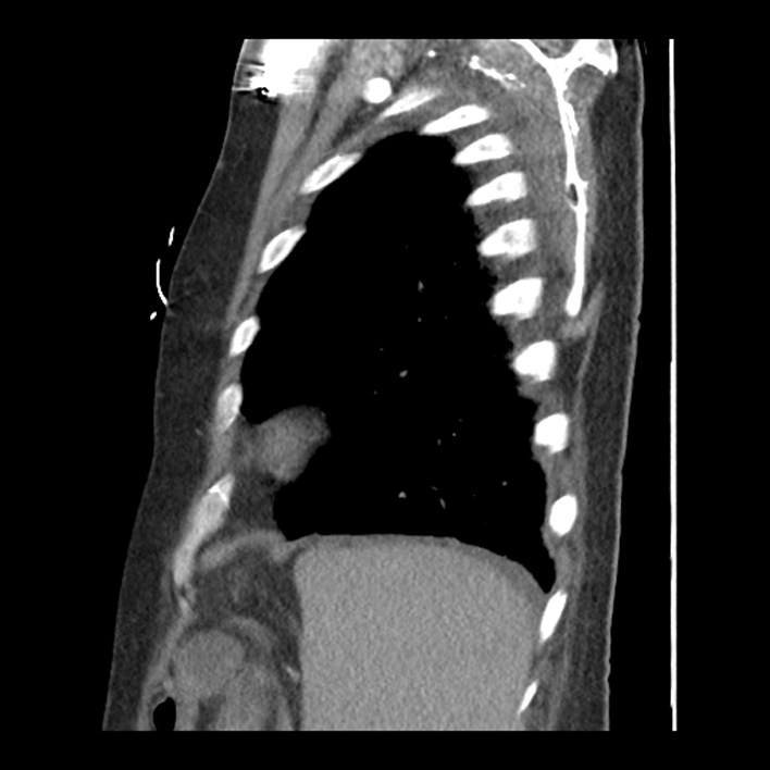 Aortic arch graft infection (FDG PET-CT) (Radiopaedia 71975-82437 C 57).jpg